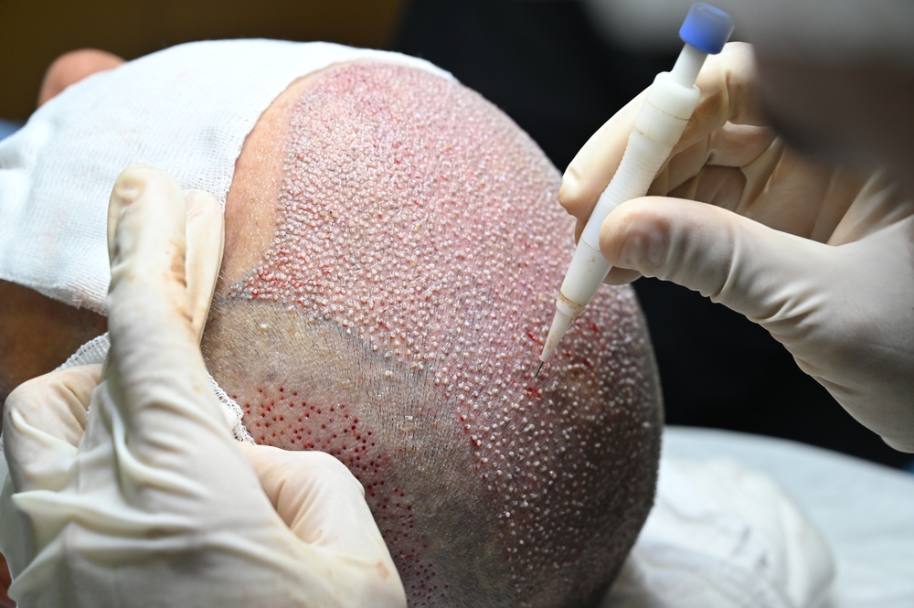 Hair Transplant in Istanbul | 2025 Prices, Techniques & Best Clinics